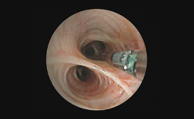 EB-710P (Slim Standard Bronchoscope)